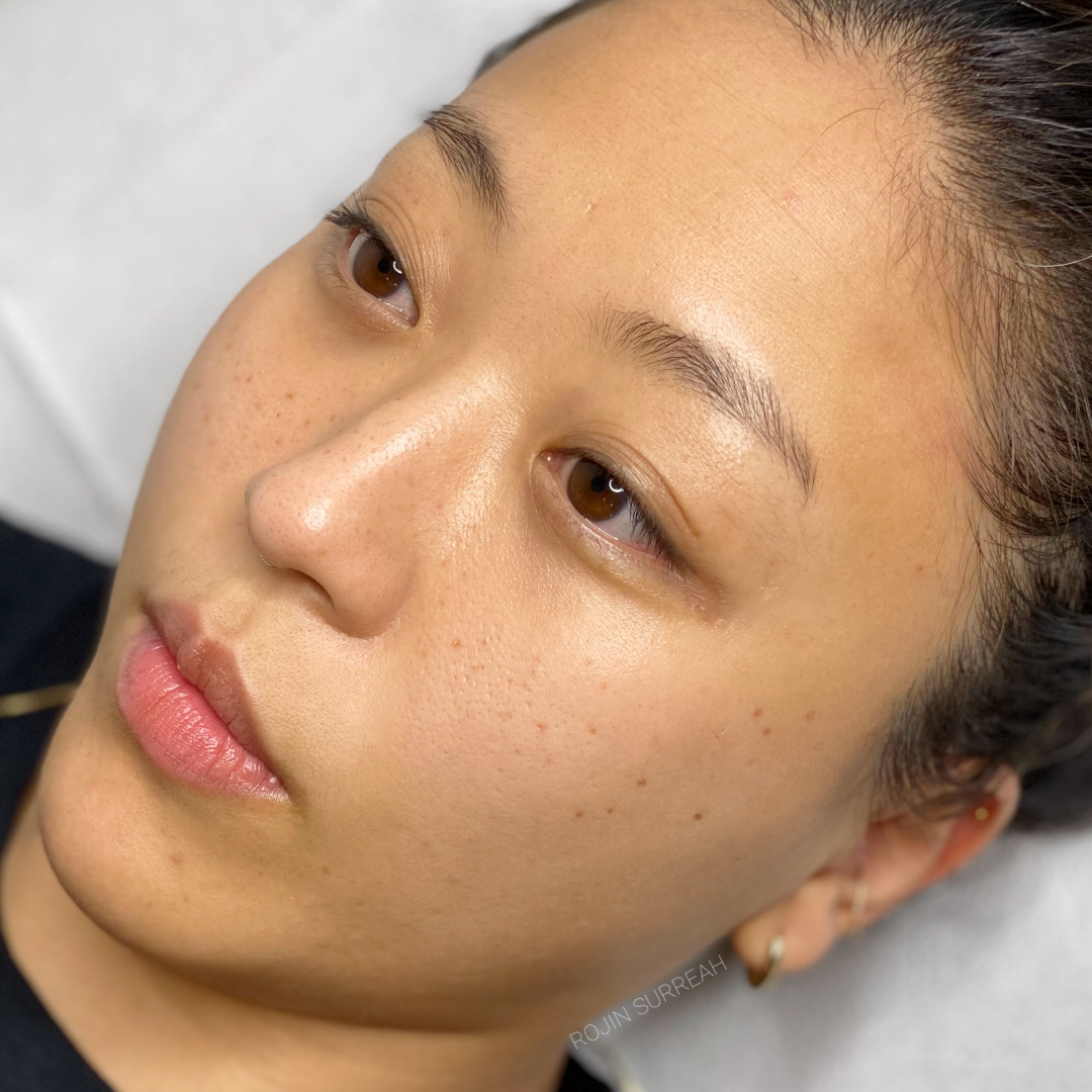 Healed freckles on a female client.